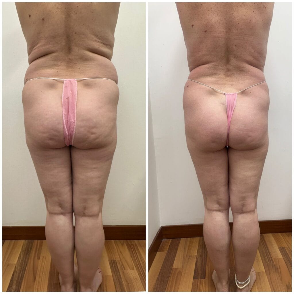 Se muestra un cambio corporal de gran impacto con sesiones de Radio frecuencia corporal